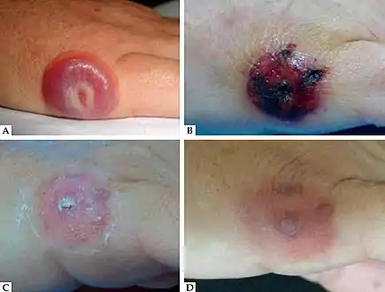 Human skin infected with paravaccinia virus.