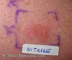 Positive patch test to nitrile