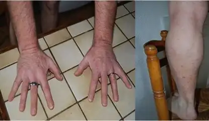 After treatment