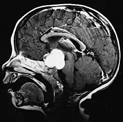 Pilocytic astrocytoma in the hypothalamic region.