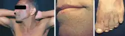 Acanthosis nigricans in GI cancer