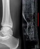 Achilles tendon rupture seen on ultrasound. Note discontinuity over several centimeters (red line). No fracture or avulsion (radiograph).