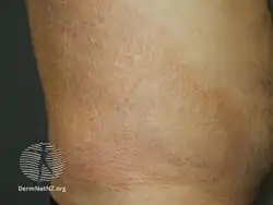 Ichthyosis acquisita