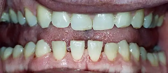 Lower jaw showing the classic spacing of teeth due to acromegaly