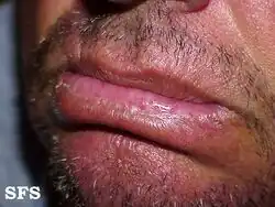Actinic cheilitis