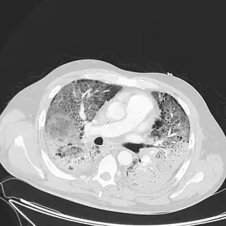 Acute respiratory distress syndrome