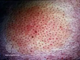 Alopecia mucinosa