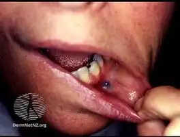 Amalgam tattoo