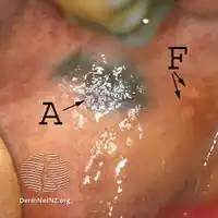 Amalgam tattoo