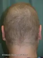 Anagen effluvium- regrowth after chemotherapy