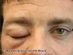 Angioedema