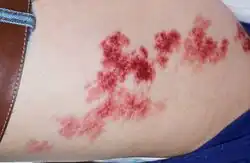 Angiokeratoma