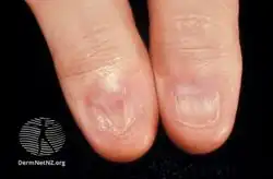 Anonychia