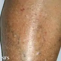 Asteatotic dermatitis