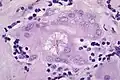 Asteroid body in sarcoidosis