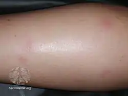 Bedbug bites