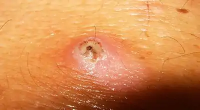 Skin infection with Tunga penetrans in a human