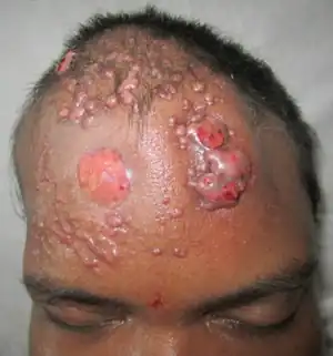 Botryomycosis