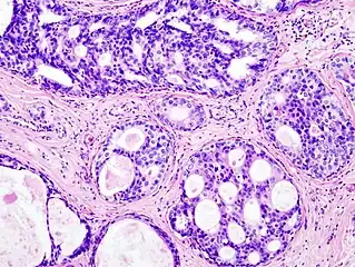 Histopathologic image from ductal cell carcinoma in situ (DCIS) of breast. Hematoxylin and eosin stain.