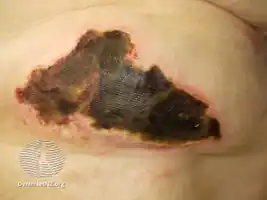 Calciphylaxis