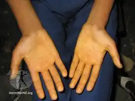 Carotenaemia