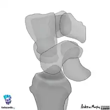 Lunate dislocation