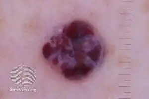 Cavernous haemangioma, polarised dermoscopy view