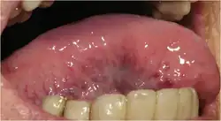 Caviar tongue grade 1