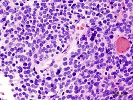 Cerebellar medulloblastoma in an adult