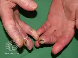 Chilblain lupus