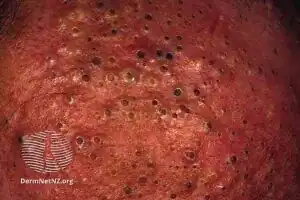 Chloracne/Blackheads