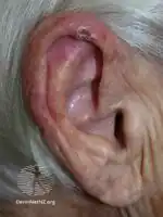 Chondrodermatitis nodularis helicis