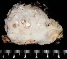 Chronic pancreatitis