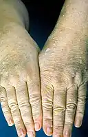Displaying typical trichilemmomas on the bilateral dorsal hands