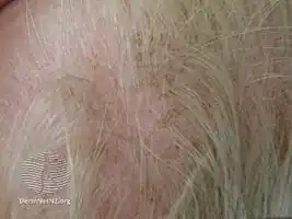 Cradle cap