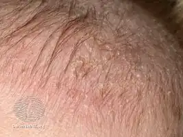 Cradle cap