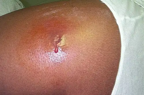 A person's thigh with a red area that is inflamed. At the centre of the inflammation is a wound with pus.