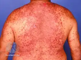Skin reaction to an anticonvulsant