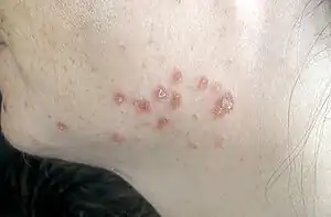 Multiple reddish-brownish papules and plaques on the left mandibular region of an adult face