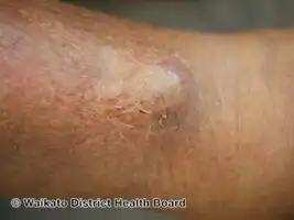 Plasmacytoma