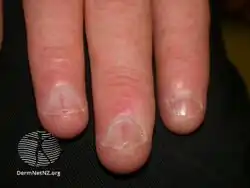 Darier disease