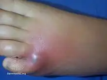 Spider bite-day 2