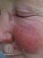 Erysipelas face