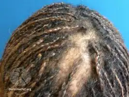 Central centrifugal cicatricial alopecia