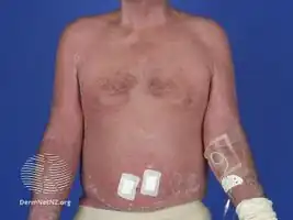Erythroderma