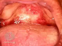 An example of herpangina