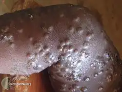 Mpox