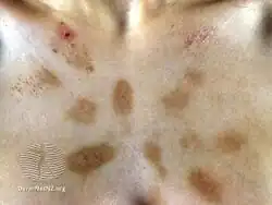 Factitious dermatitis