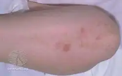 Dermatitis herpetiformis
