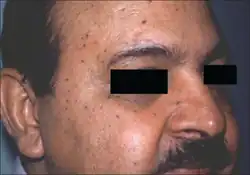 Dermatosis papulosa nigra